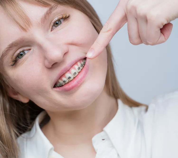 Jeune femme qui montre ses boîtiers orthodontiques métalliques